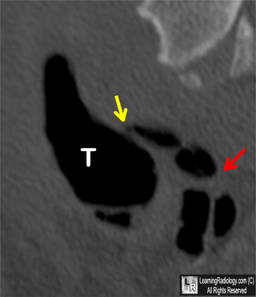 paratracheal air cyst